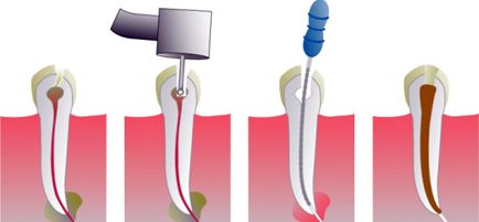 centro-dental-epadent-ilustracion-de-endodoncia